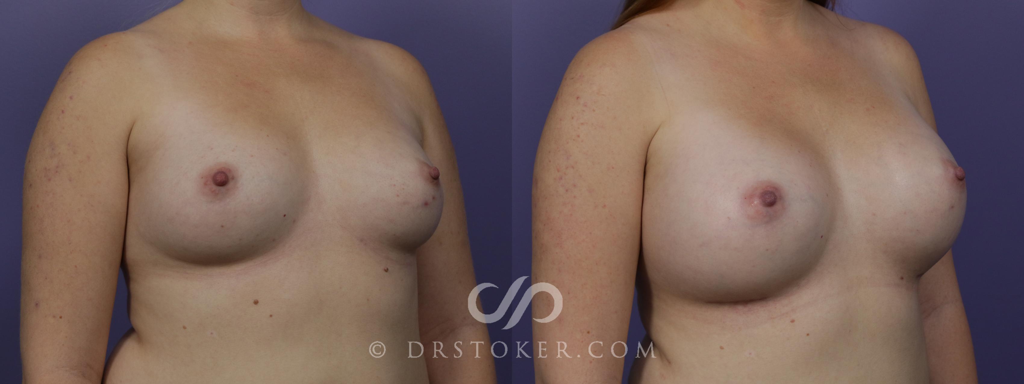 Before & After Breast Augmentation, Rapid Recovery Case 1513 View #2 View in Los Angeles, CA