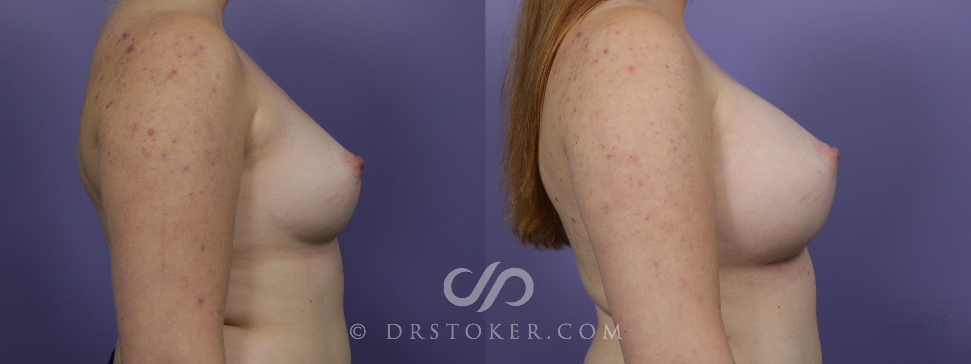 Before & After Breast Augmentation, Rapid Recovery Case 1513 View #3 View in Los Angeles, CA