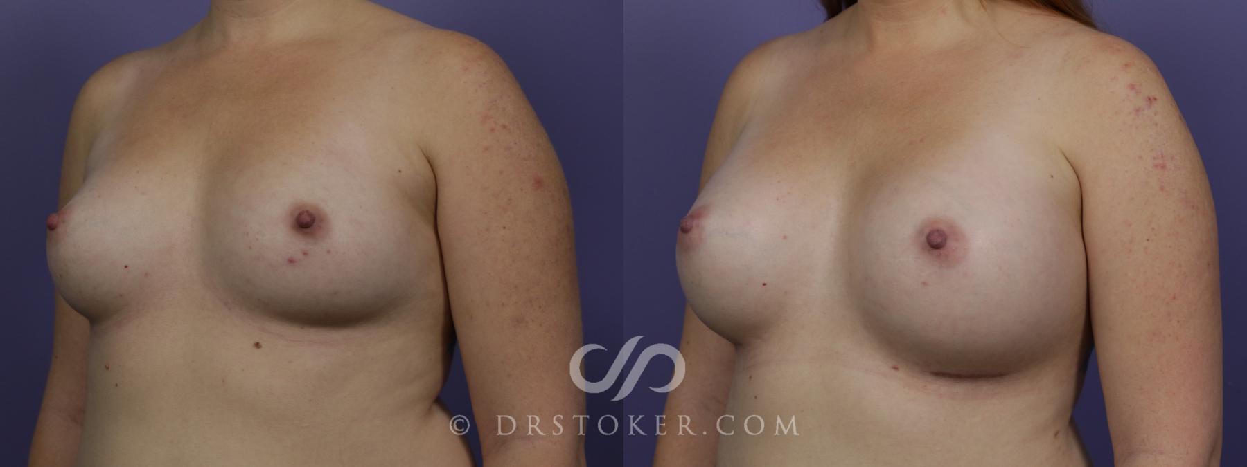 Before & After Breast Augmentation, Rapid Recovery Case 1513 View #4 View in Los Angeles, CA