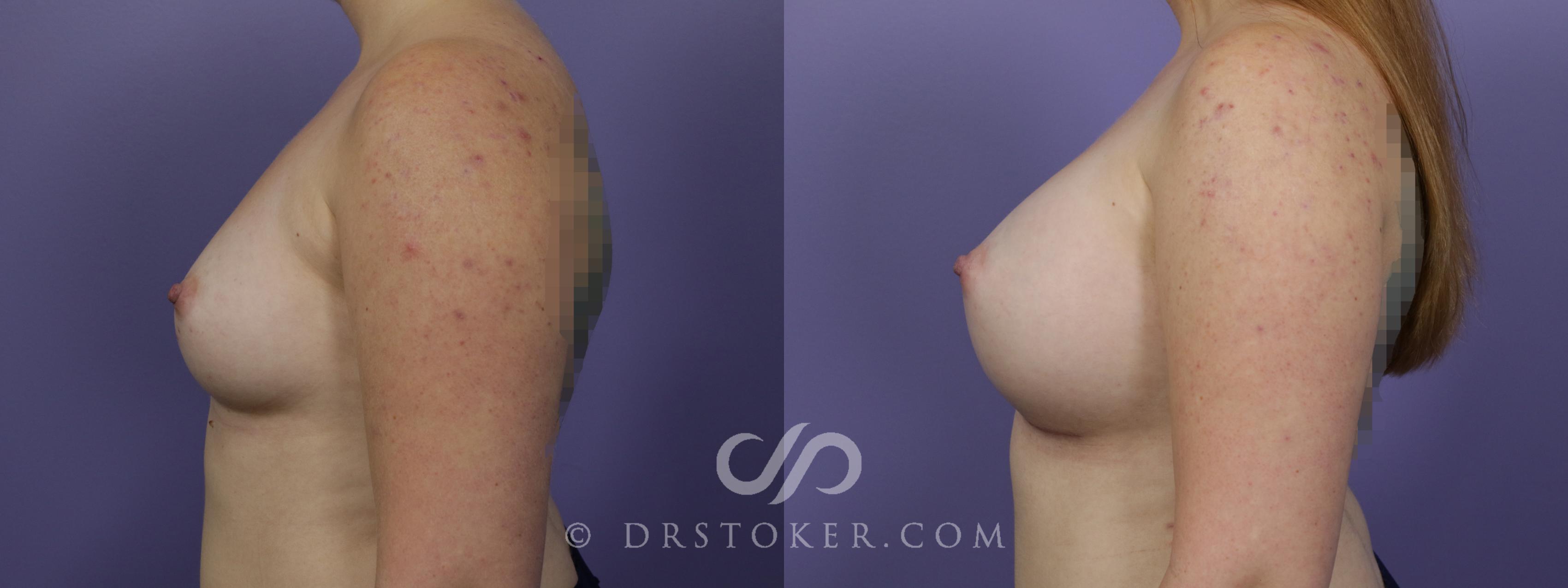 Before & After Breast Augmentation, Rapid Recovery Case 1513 View #5 View in Los Angeles, CA