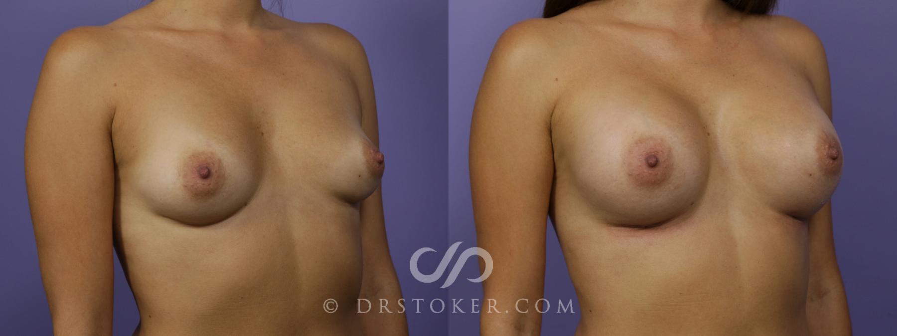 Before & After Breast Augmentation, Rapid Recovery Case 1517 View #2 View in Los Angeles, CA