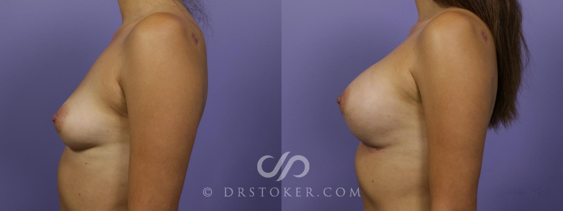 Before & After Breast Augmentation, Rapid Recovery Case 1517 View #5 View in Los Angeles, CA