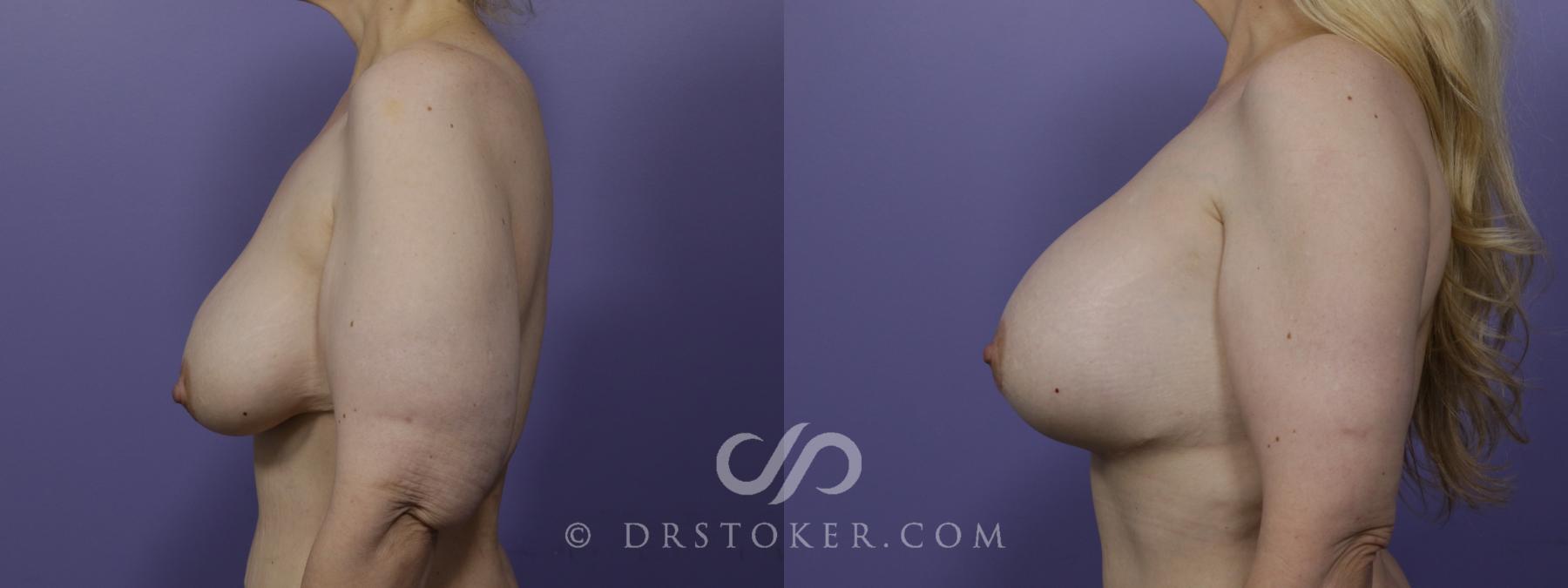 Before & After Breast Implant Correction Case 1519 View #5 View in Los Angeles, CA