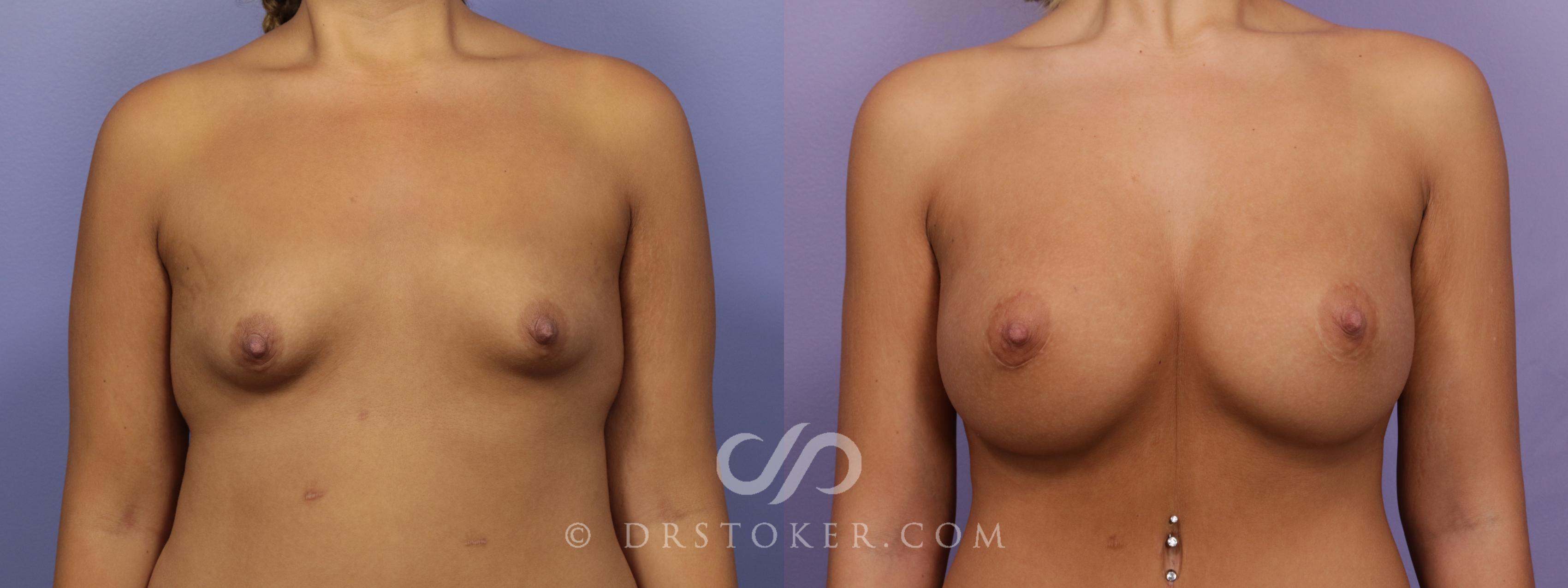 Before & After Breast Augmentation, Rapid Recovery Case 1725 View #1 View in Los Angeles, CA