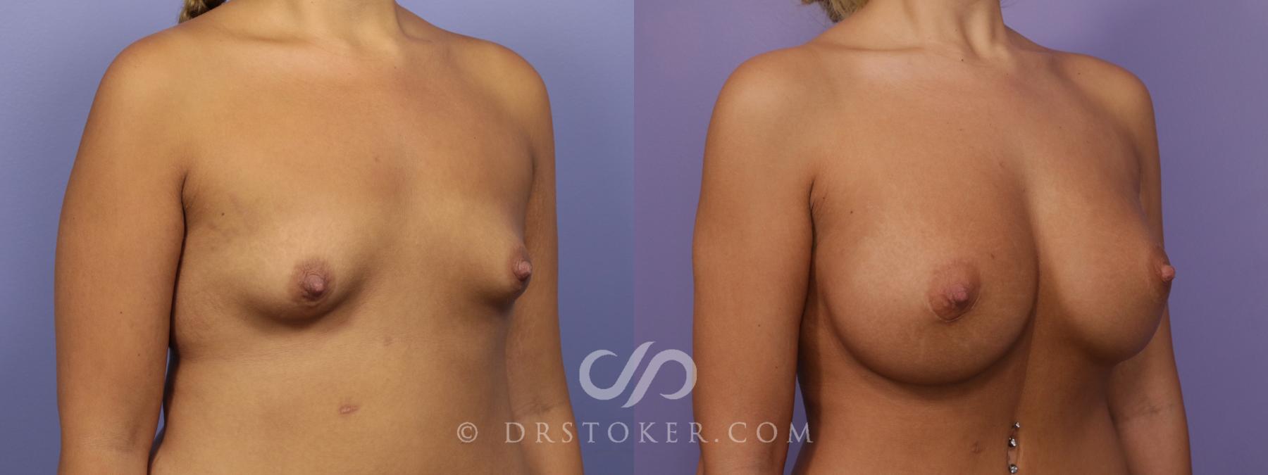 Before & After Breast Augmentation, Rapid Recovery Case 1725 View #2 View in Los Angeles, CA