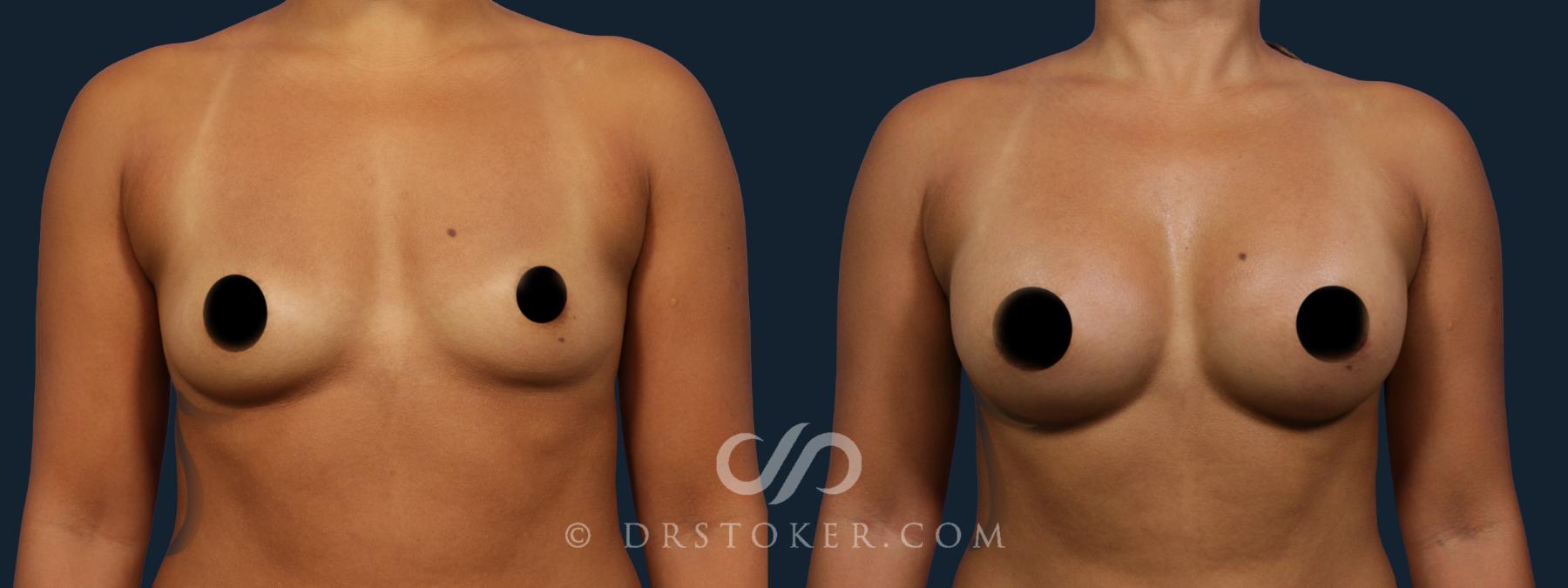 Before & After Breast Augmentation, Rapid Recovery Case 1792 Front View in Los Angeles, CA