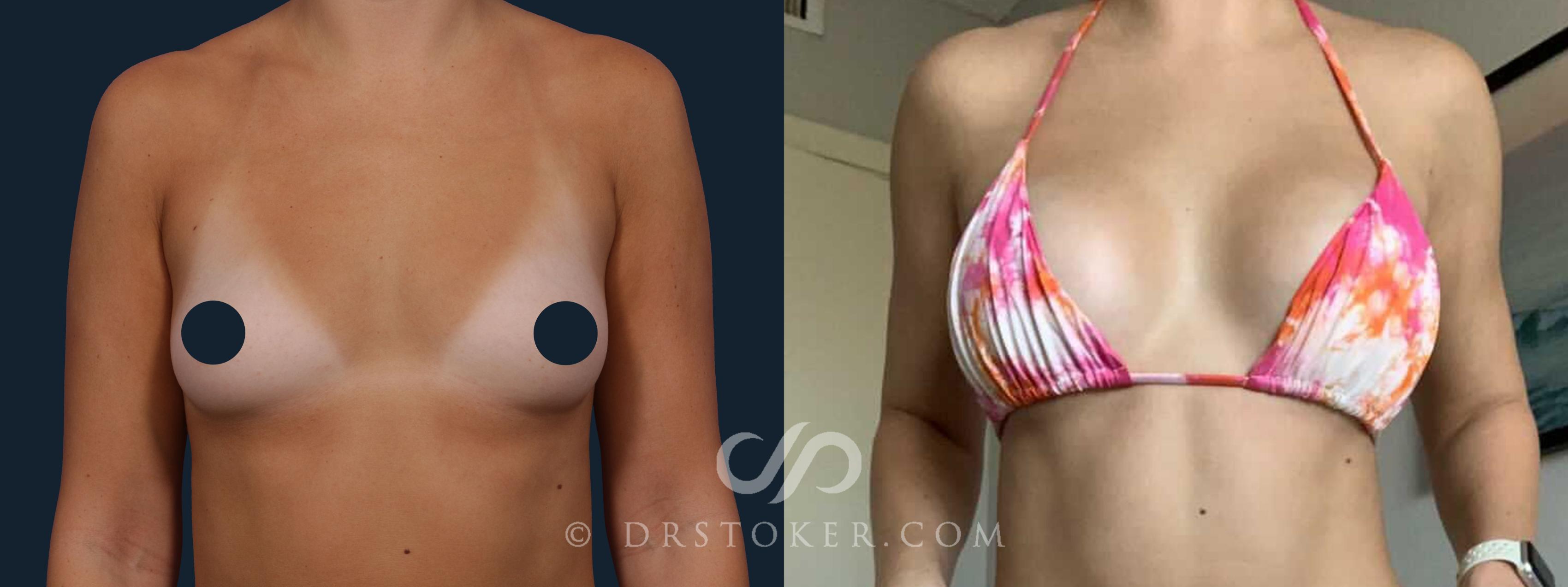 Before & After Breast Augmentation, Rapid Recovery Case 1793 Front View in Los Angeles, CA