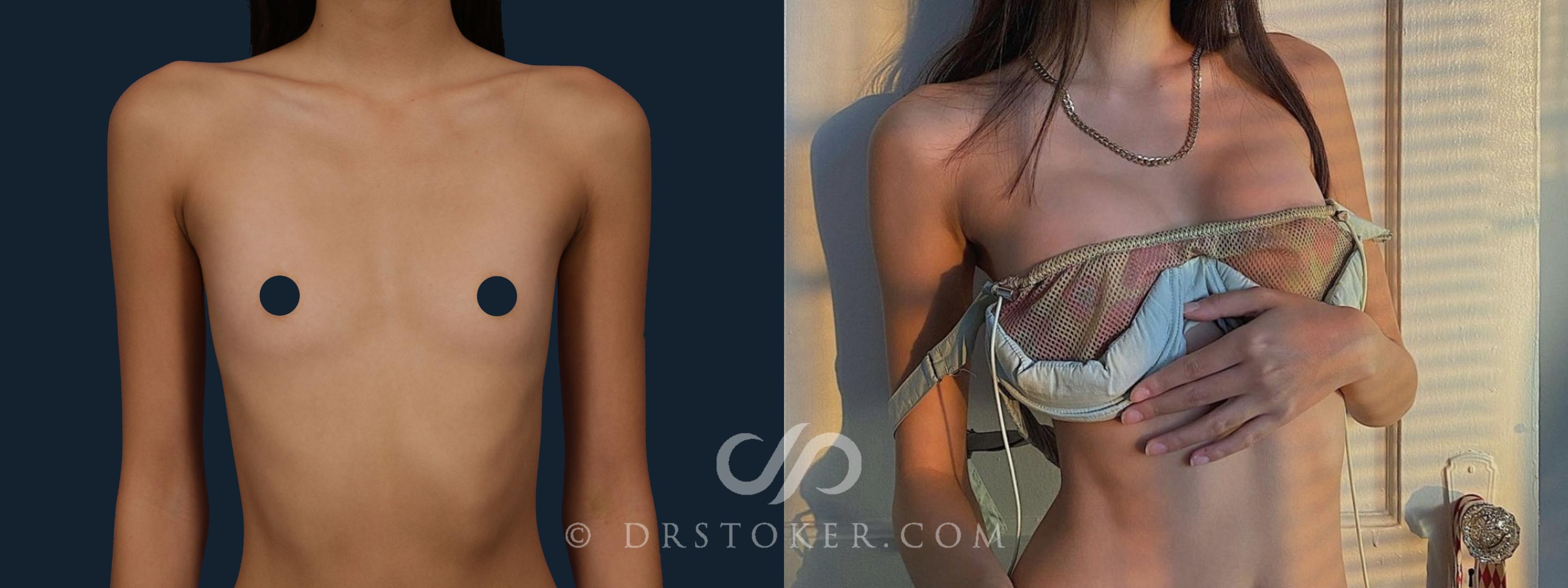 Before & After Breast Augmentation, Rapid Recovery Case 1794 Front View in Los Angeles, CA