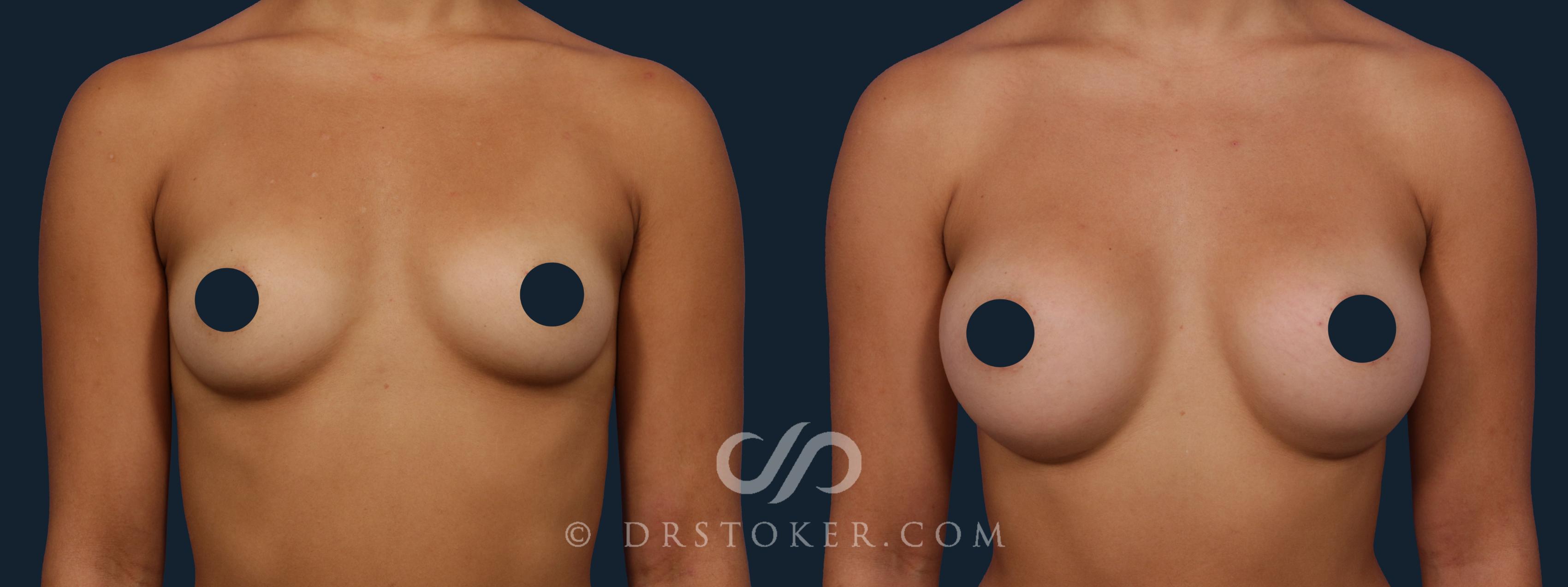 Before & After Breast Augmentation, Rapid Recovery Case 1795 Front View in Los Angeles, CA