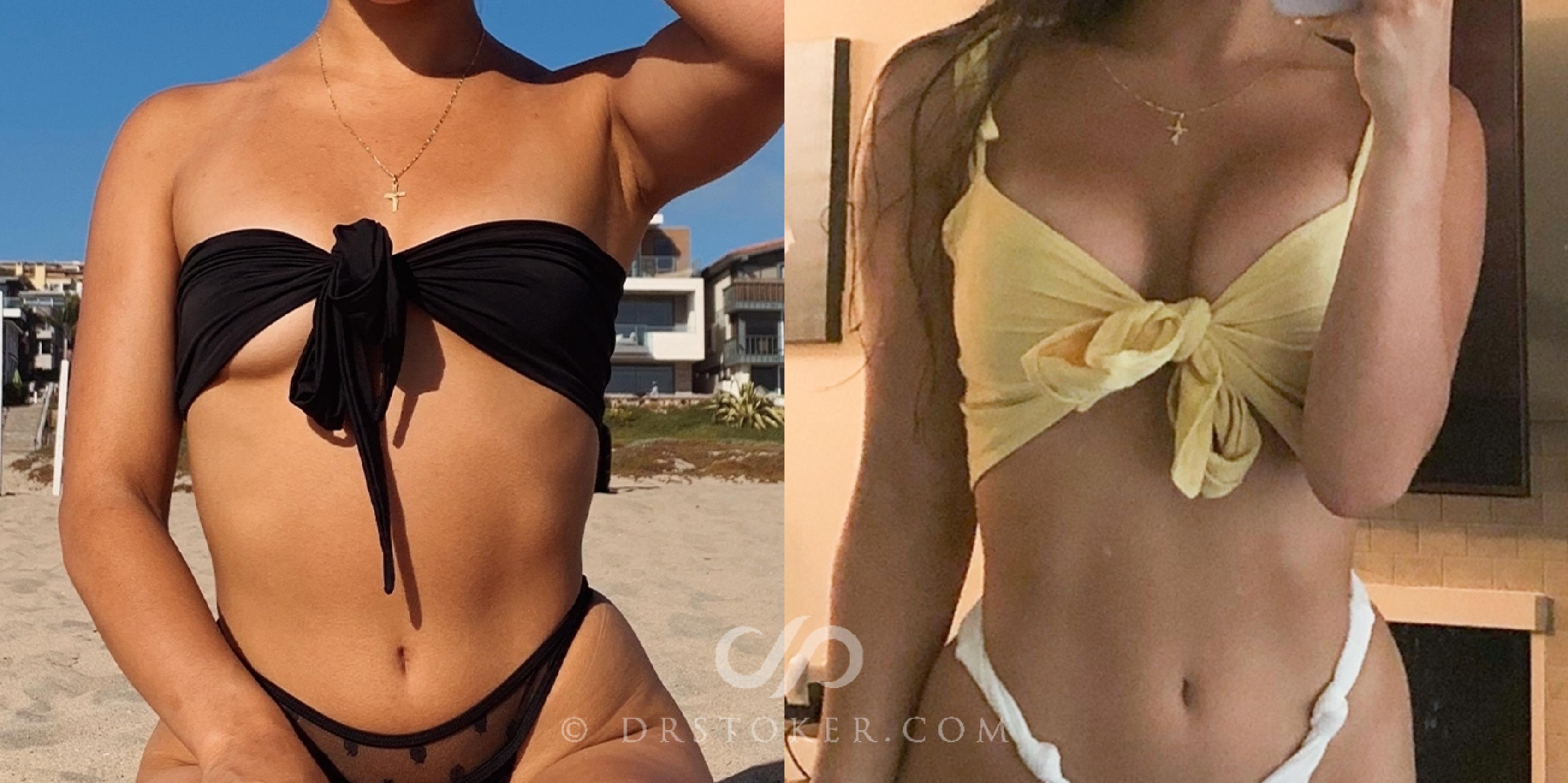 Before & After Breast Augmentation, Rapid Recovery Case 1796 Front View in Los Angeles, CA