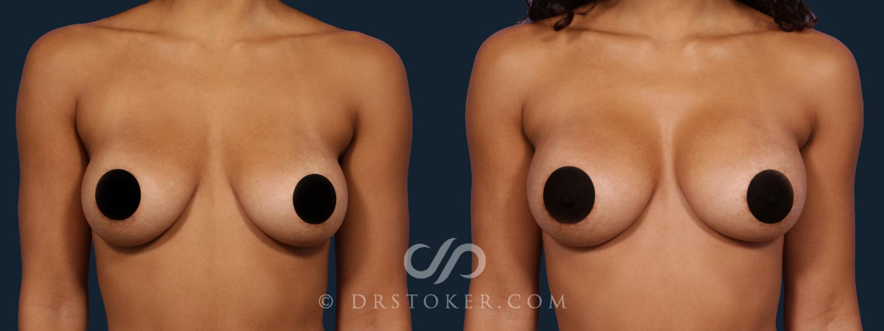 Before & After Breast Augmentation, Rapid Recovery Case 1801 Front View in Los Angeles, CA