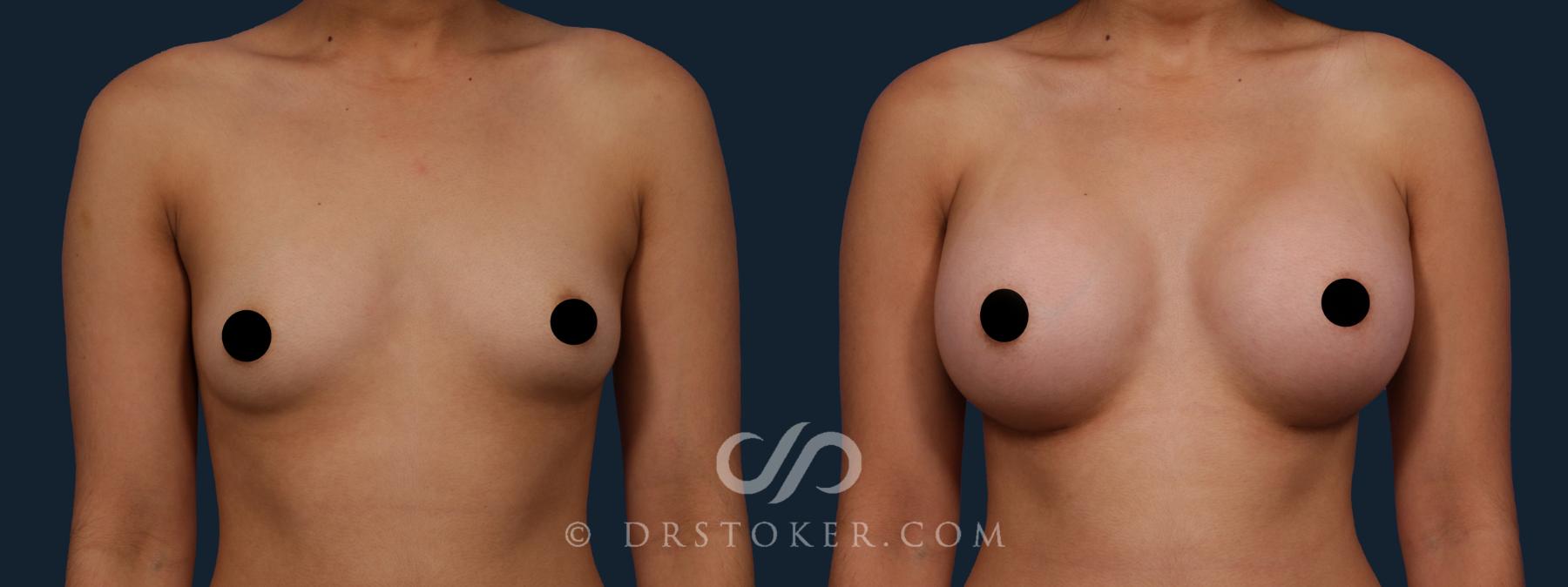Before & After Breast Augmentation, Rapid Recovery Case 1876 Front View in Los Angeles, CA