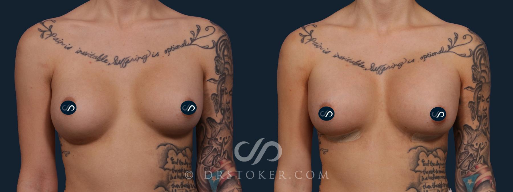 Before & After Breast Augmentation, Rapid Recovery Case 1878 Front View in Los Angeles, CA