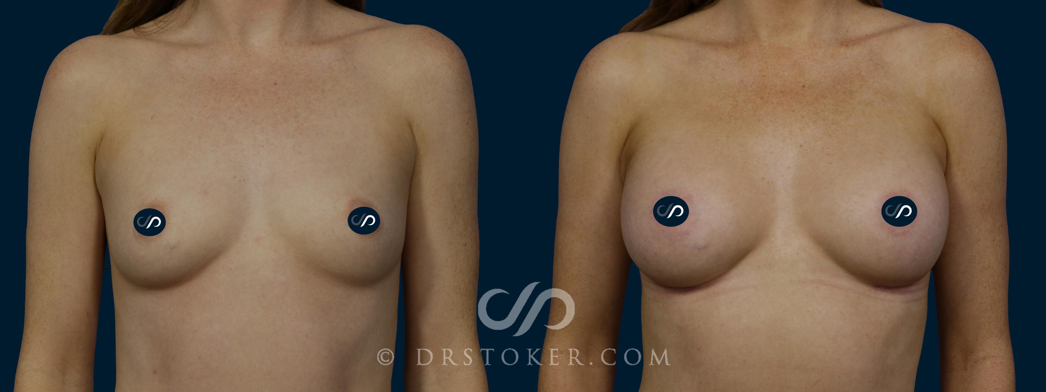 Before & After Breast Augmentation, Rapid Recovery Case 1879 Front View in Los Angeles, CA