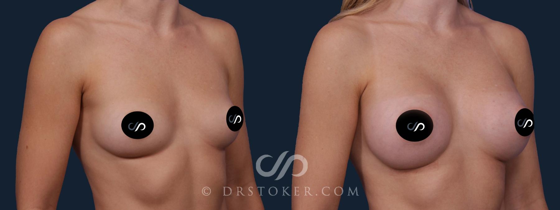 Before & After Breast Augmentation, Rapid Recovery Case 1894 Right Oblique View in Los Angeles, CA