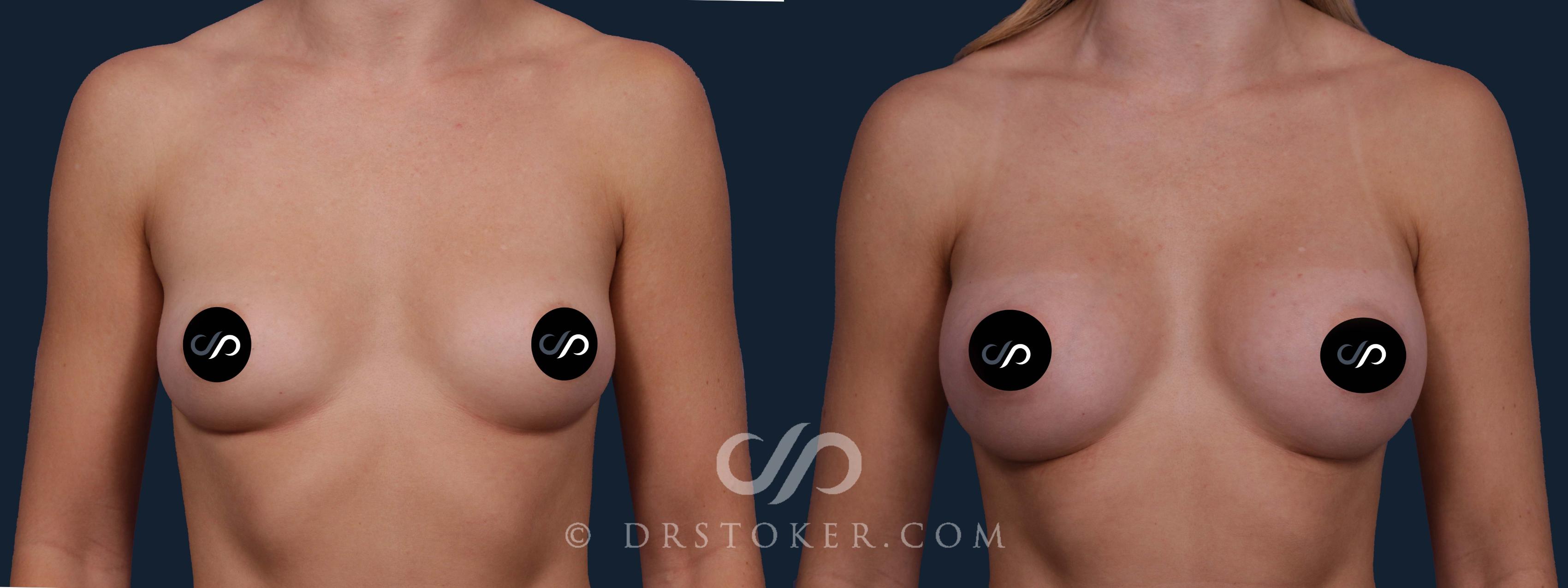 Before & After Breast Augmentation, Rapid Recovery Case 1895 Front View in Los Angeles, CA