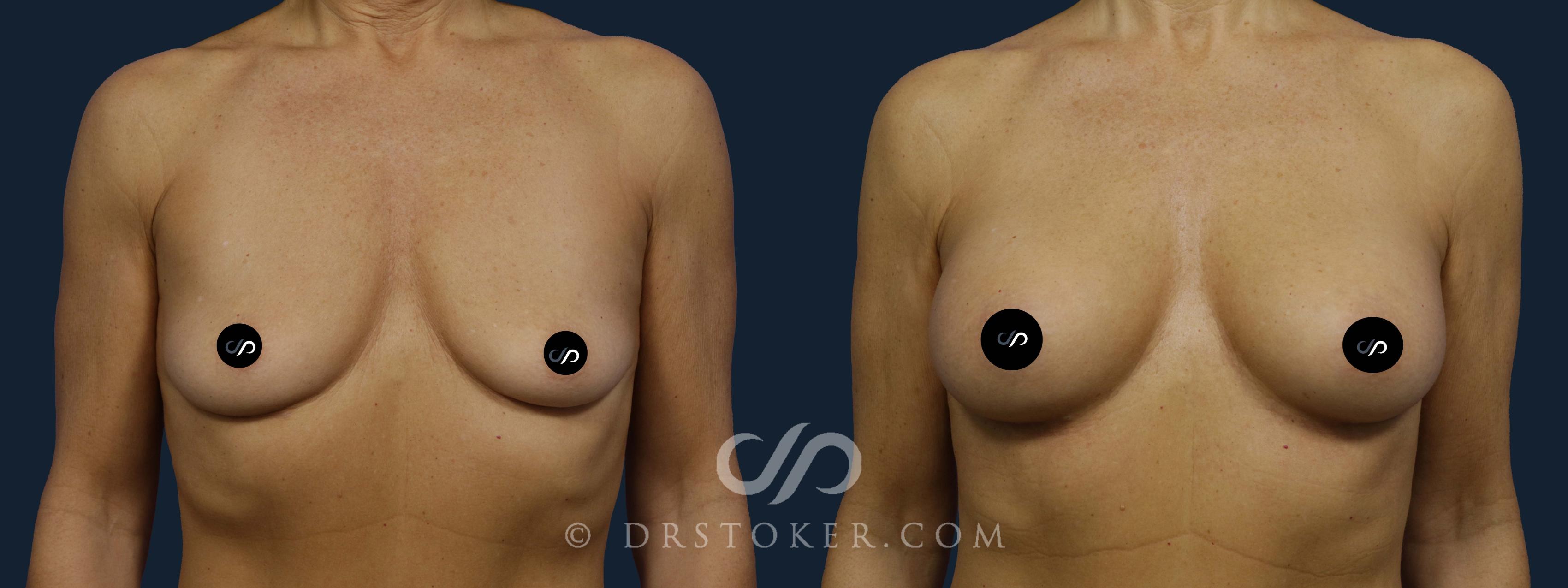 Before & After Breast Augmentation, Rapid Recovery Case 1897 Front View in Los Angeles, CA