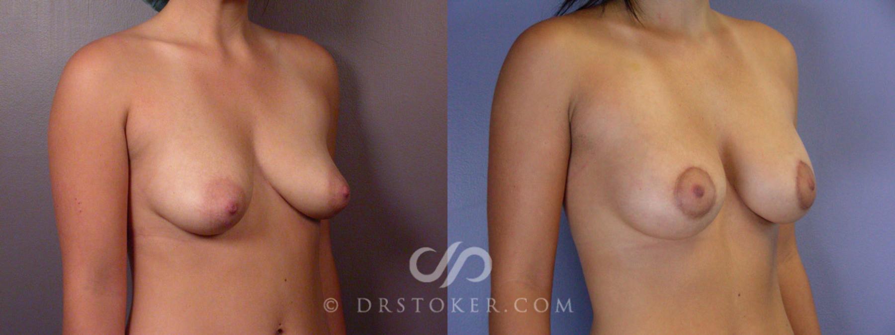 Before & After Breast Lift Case 190 View #2 View in Los Angeles, CA