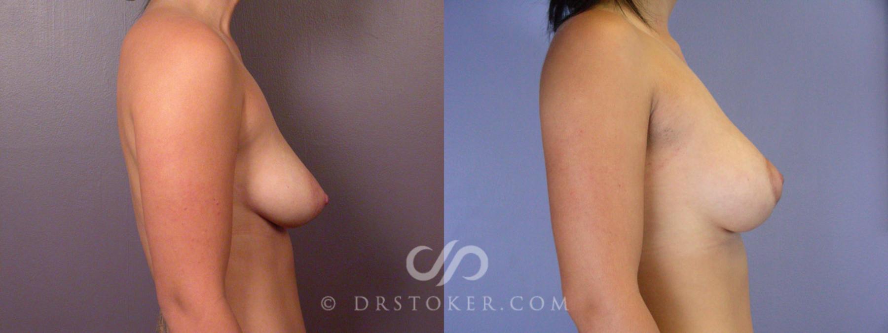 Before & After Breast Lift Case 190 View #4 View in Los Angeles, CA