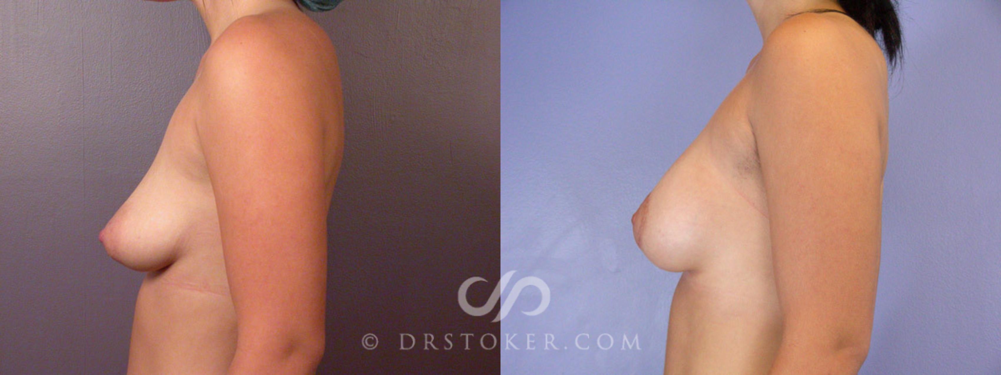 Before & After Breast Augmentation, Rapid Recovery Case 190 View #5 View in Los Angeles, CA