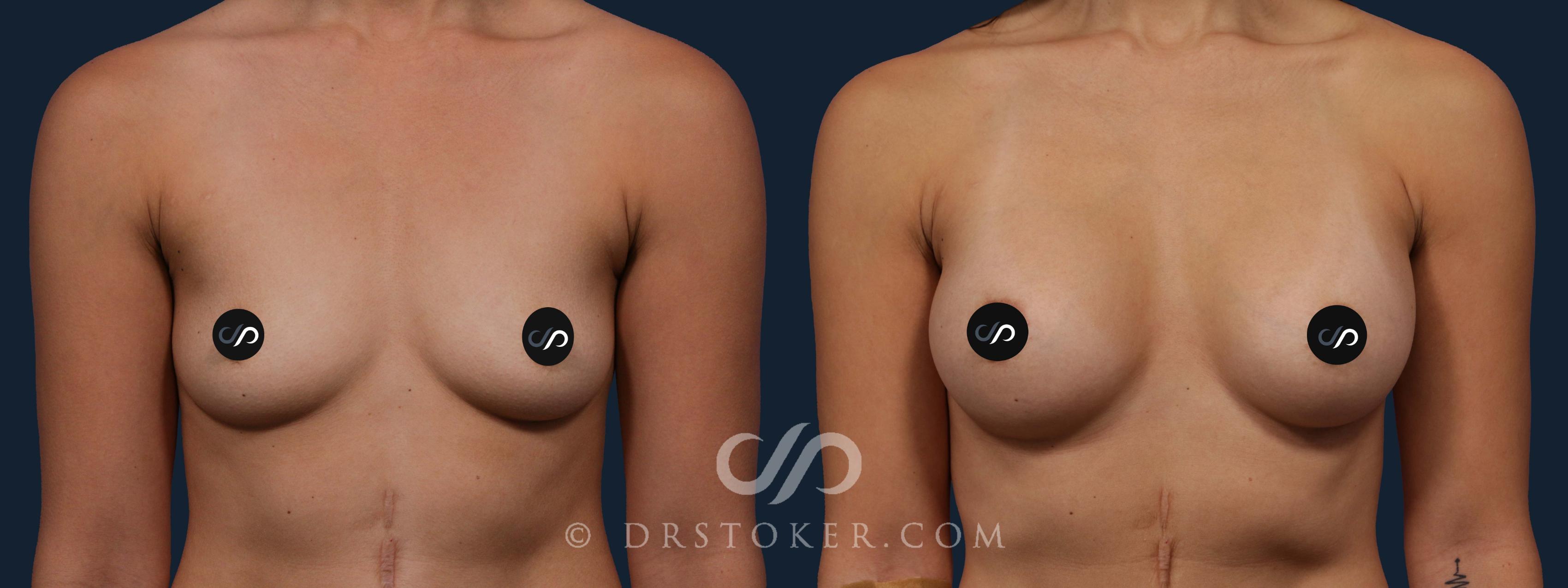 Before & After Breast Augmentation, Rapid Recovery Case 1906 Front View in Los Angeles, CA