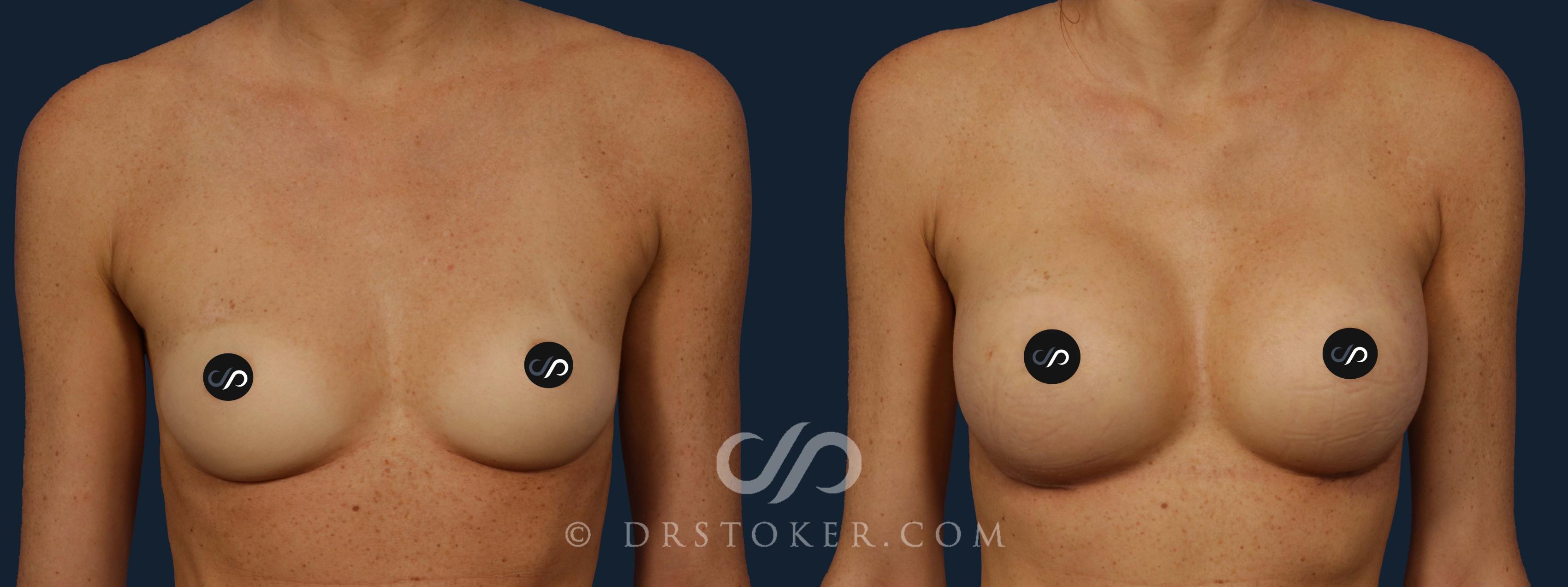 Before & After Breast Augmentation, Rapid Recovery Case 1909 Front View in Los Angeles, CA