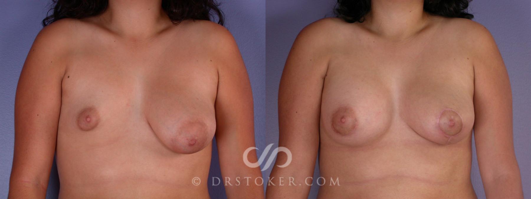 Before & After Breast Lift Case 191 View #1 View in Los Angeles, CA