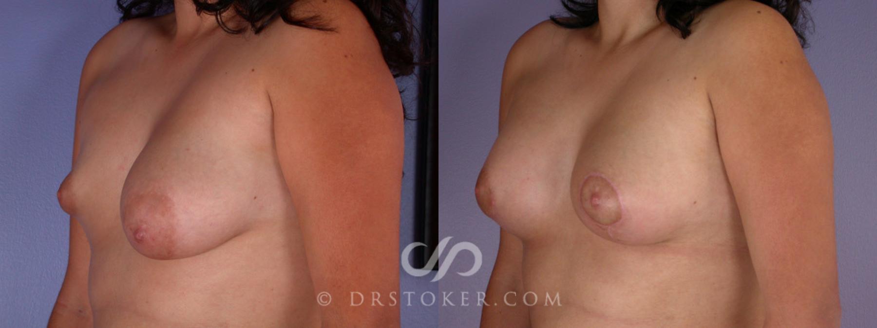 Before & After Breast Augmentation, Rapid Recovery Case 191 View #3 View in Los Angeles, CA