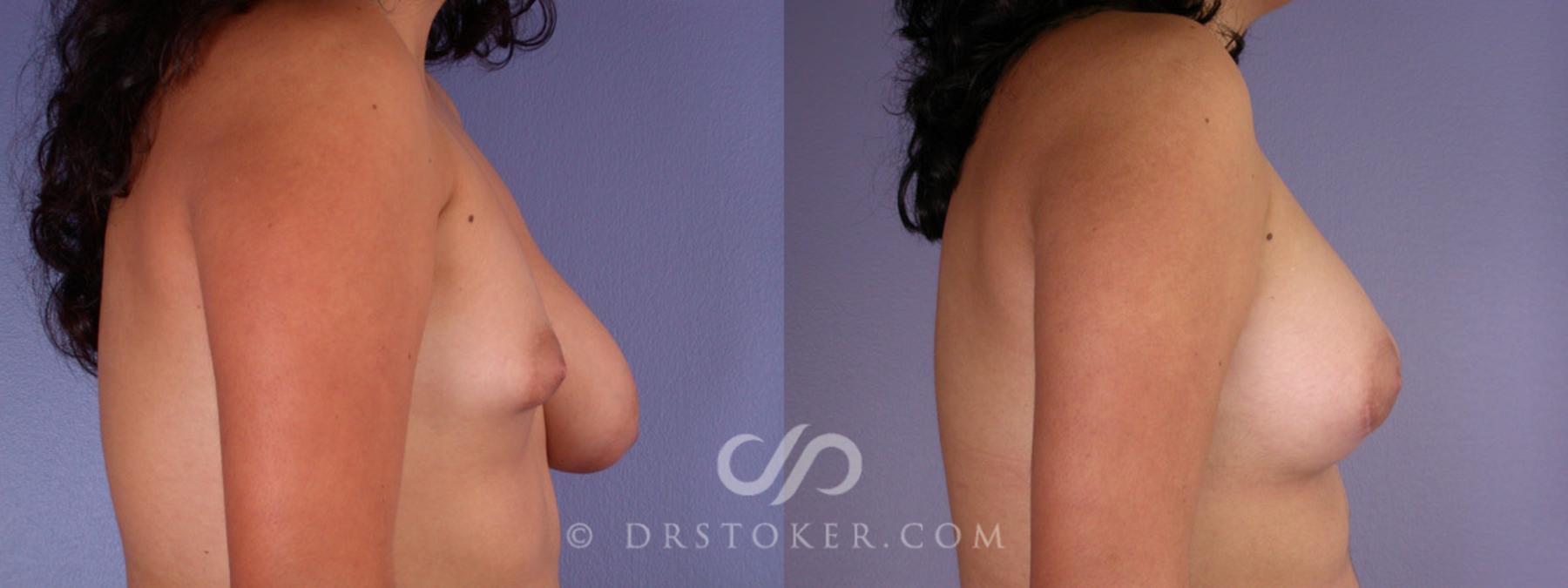 Before & After Breast Augmentation, Rapid Recovery Case 191 View #4 View in Los Angeles, CA
