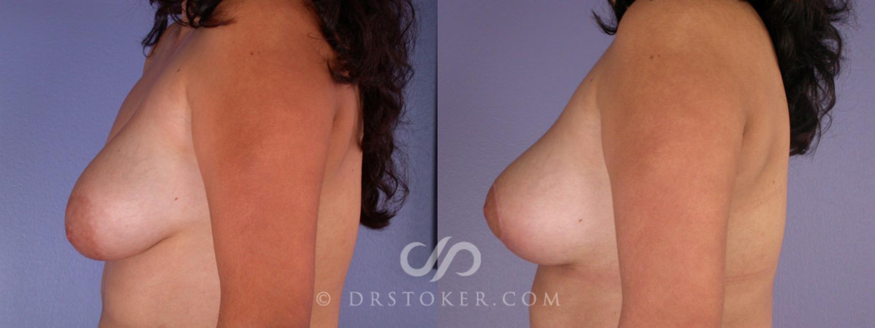 Before & After Breast Augmentation with Lift Case 191 View #5 View in Los Angeles, CA