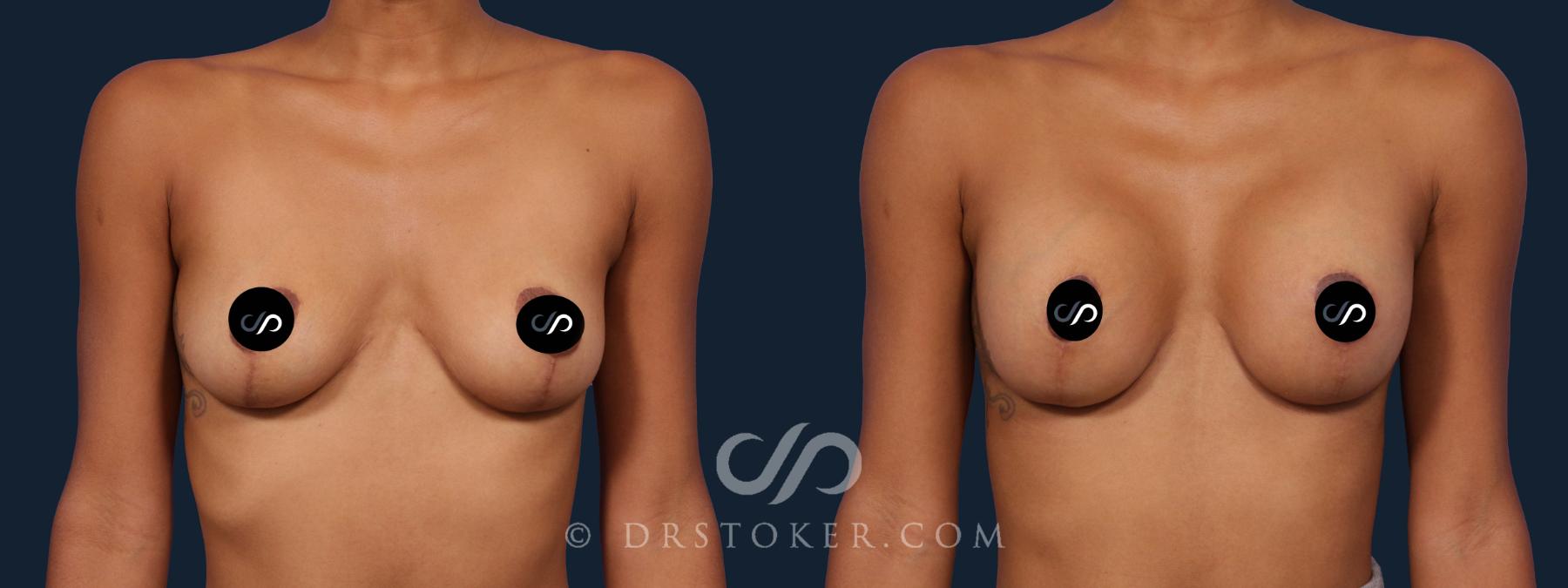 Before & After Breast Augmentation, Rapid Recovery Case 1913 Front View in Los Angeles, CA