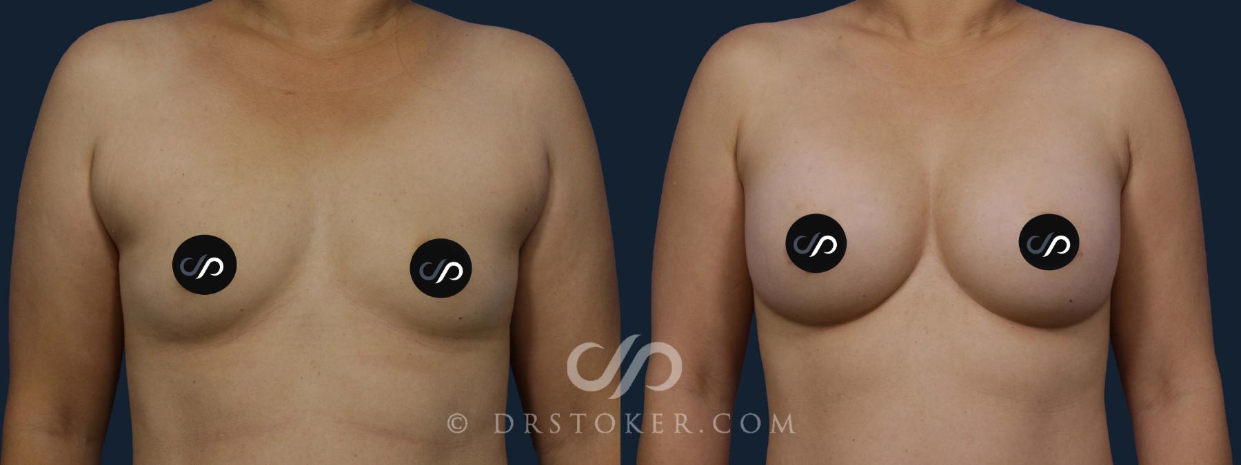 Before & After Breast Augmentation, Rapid Recovery Case 1922 Front View in Los Angeles, CA