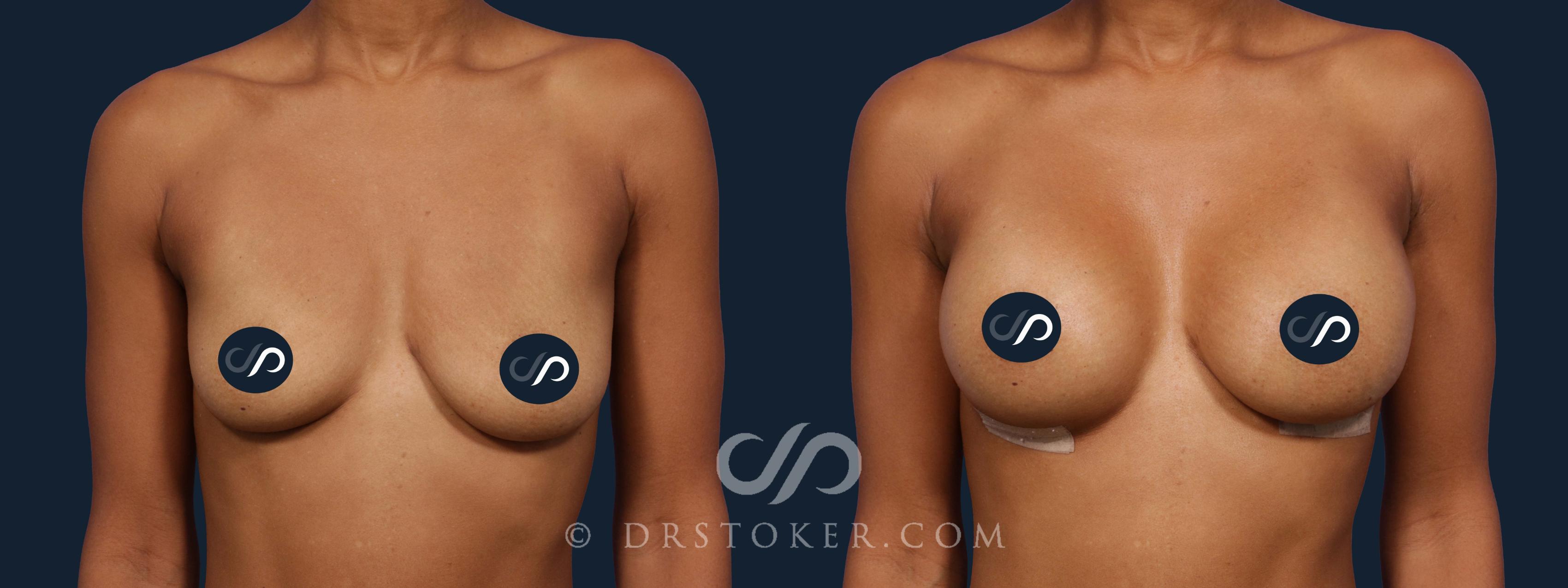 Before & After Breast Augmentation, Rapid Recovery Case 1927 Front View in Los Angeles, CA