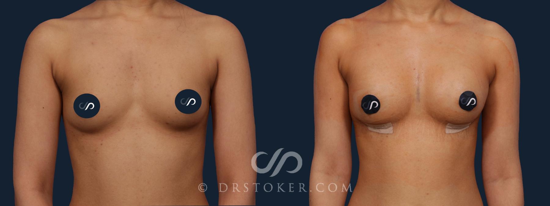 Before & After Breast Augmentation, Rapid Recovery Case 1929 Front View in Los Angeles, CA