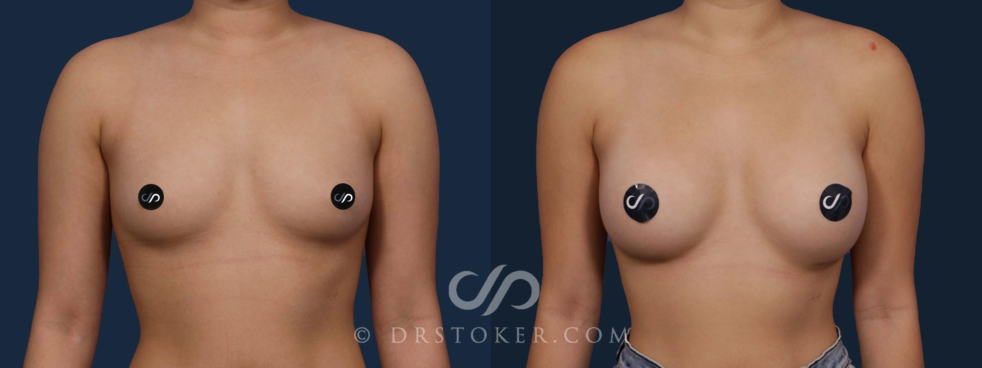 Before & After Breast Augmentation, Rapid Recovery Case 1961 Front View in Los Angeles, CA