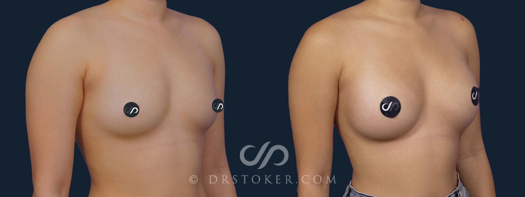 Before & After Breast Augmentation, Rapid Recovery Case 1962 Right Oblique View in Los Angeles, CA
