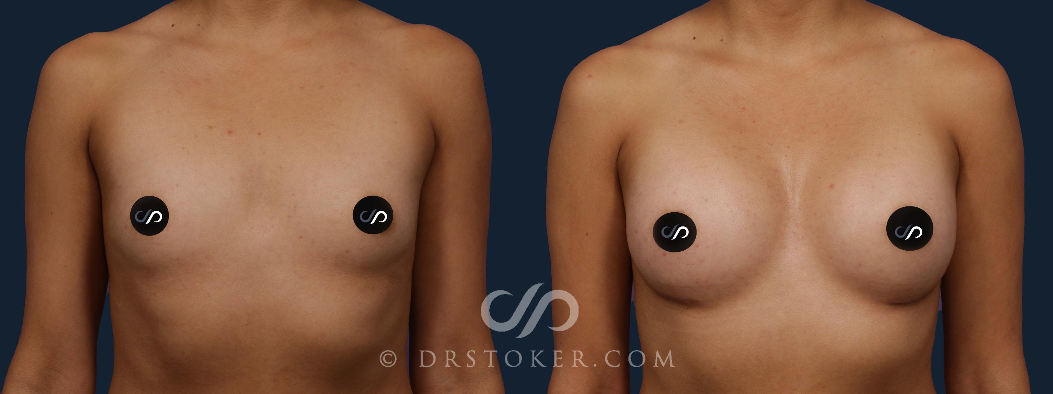 Before & After Breast Augmentation, Rapid Recovery Case 1963 Front View in Los Angeles, CA