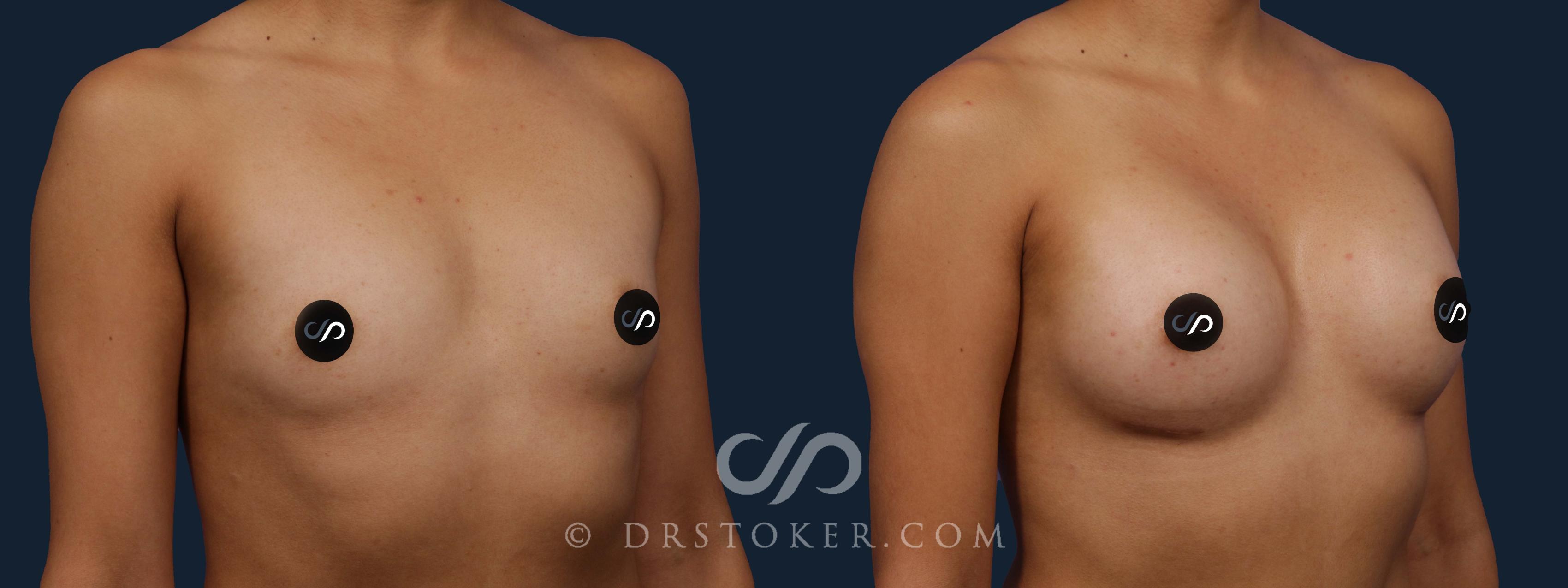 Before & After Breast Augmentation, Rapid Recovery Case 1964 Right Oblique View in Los Angeles, CA