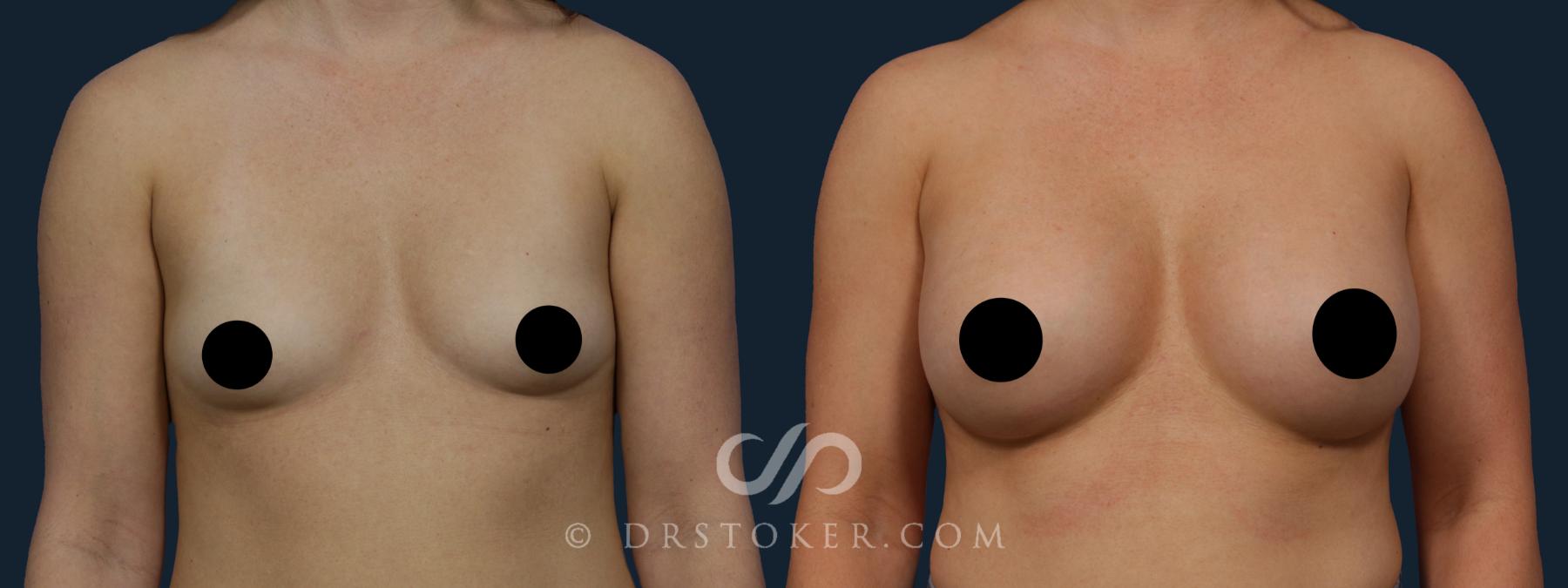 Before & After Breast Augmentation, Rapid Recovery Case 1970 Front View in Los Angeles, CA