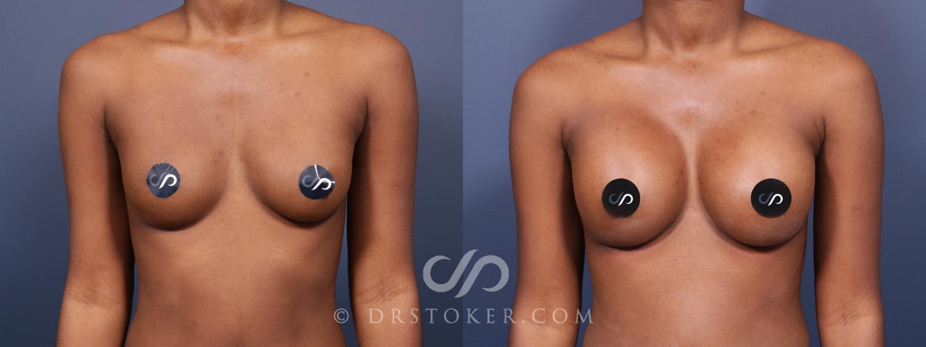 Before & After Breast Augmentation, Rapid Recovery Case 2027 Front View in Los Angeles, CA