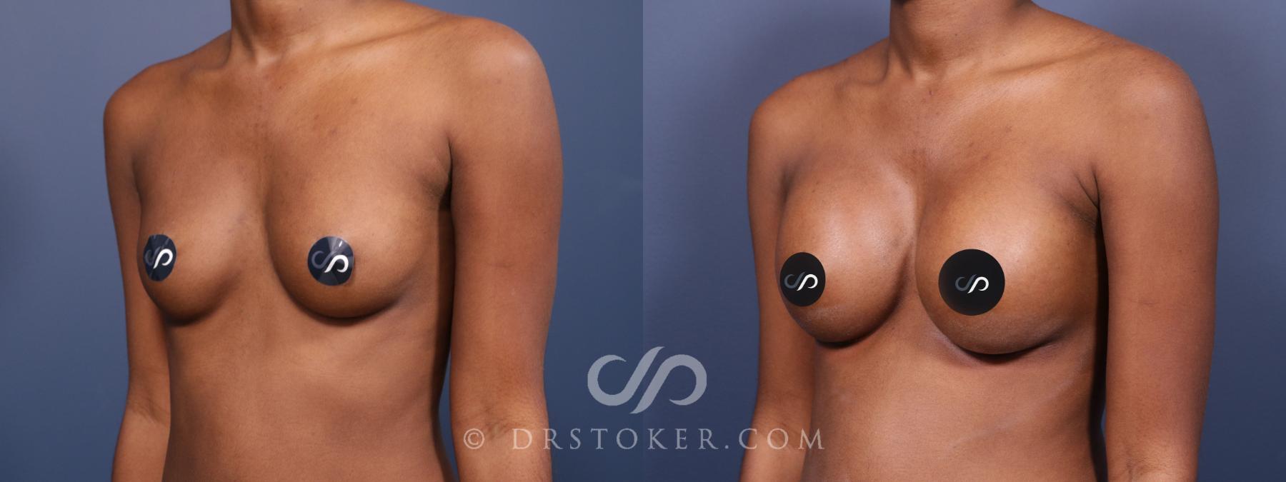 Before & After Breast Augmentation, Rapid Recovery Case 2027 Left Oblique View in Los Angeles, CA