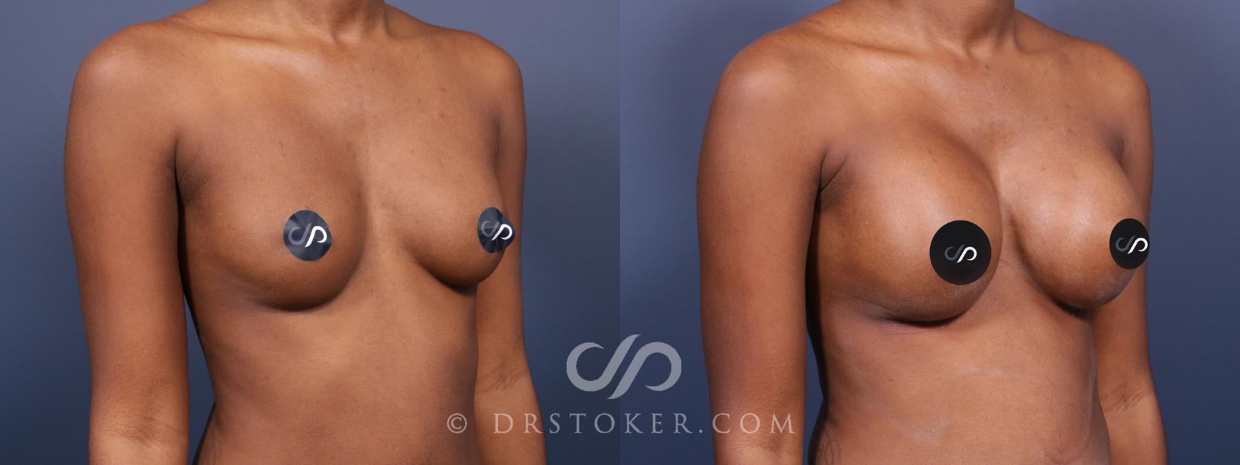 Before & After Breast Augmentation, Rapid Recovery Case 2027 Right Oblique View in Los Angeles, CA