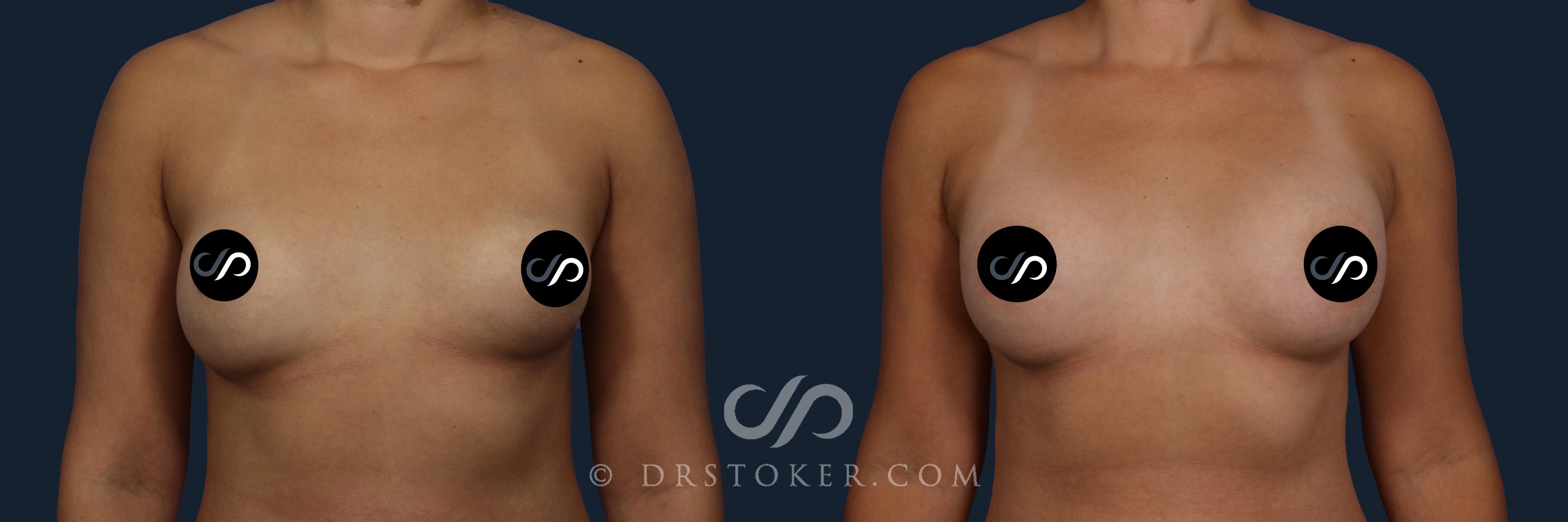 Before & After Breast Augmentation, Rapid Recovery Case 2039 Front View in Los Angeles, CA