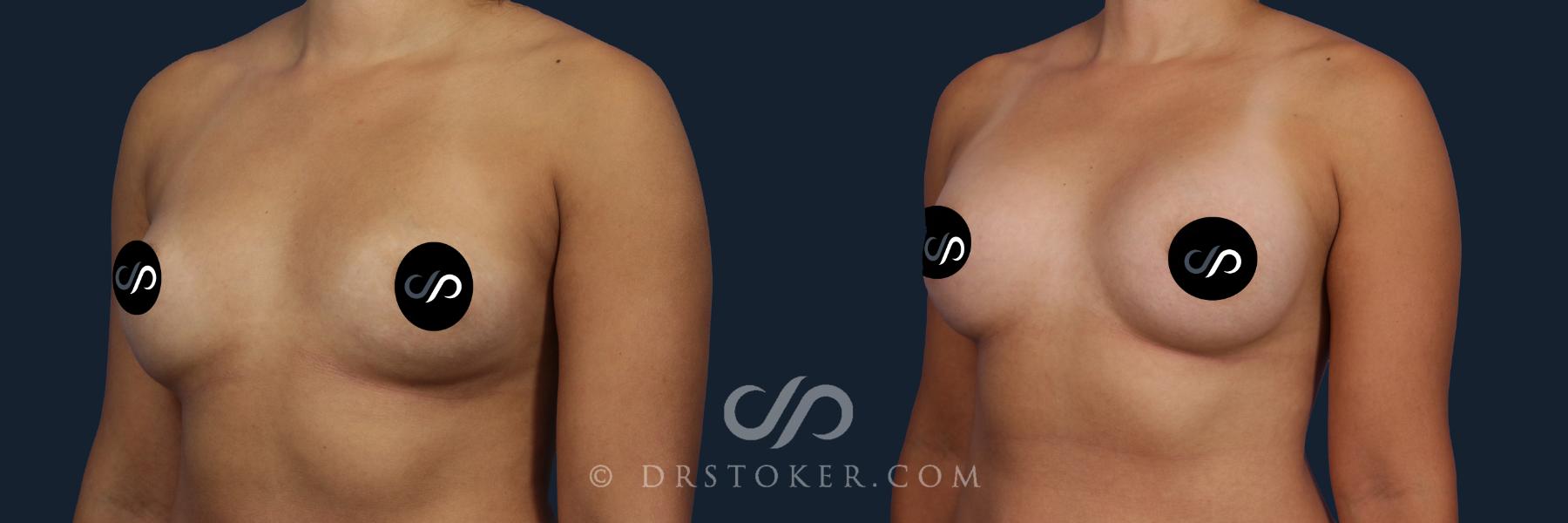 Before & After Breast Augmentation, Rapid Recovery Case 2039 Left Oblique View in Los Angeles, CA