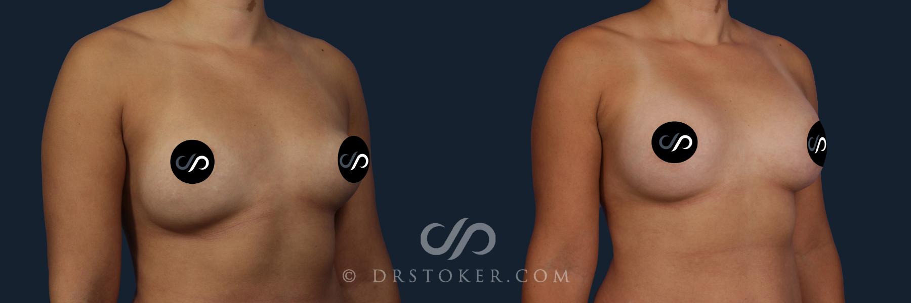 Before & After Breast Augmentation, Rapid Recovery Case 2039 Right Oblique View in Los Angeles, CA