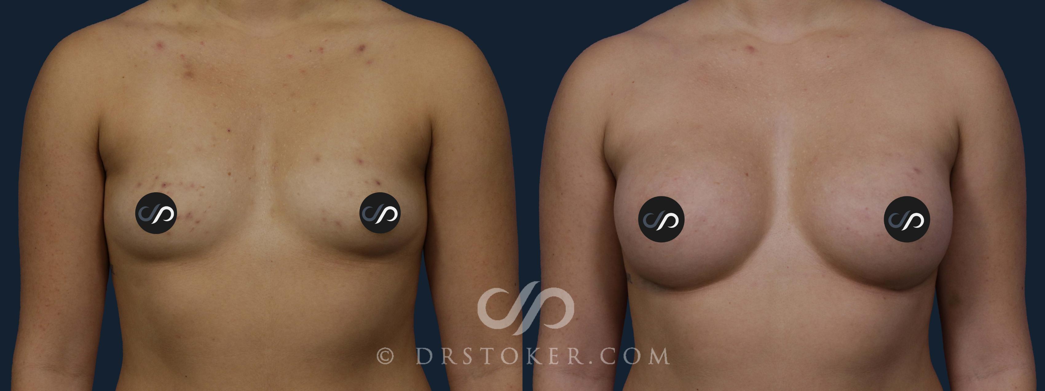 Before & After Breast Augmentation, Rapid Recovery Case 2041 Front View in Los Angeles, CA