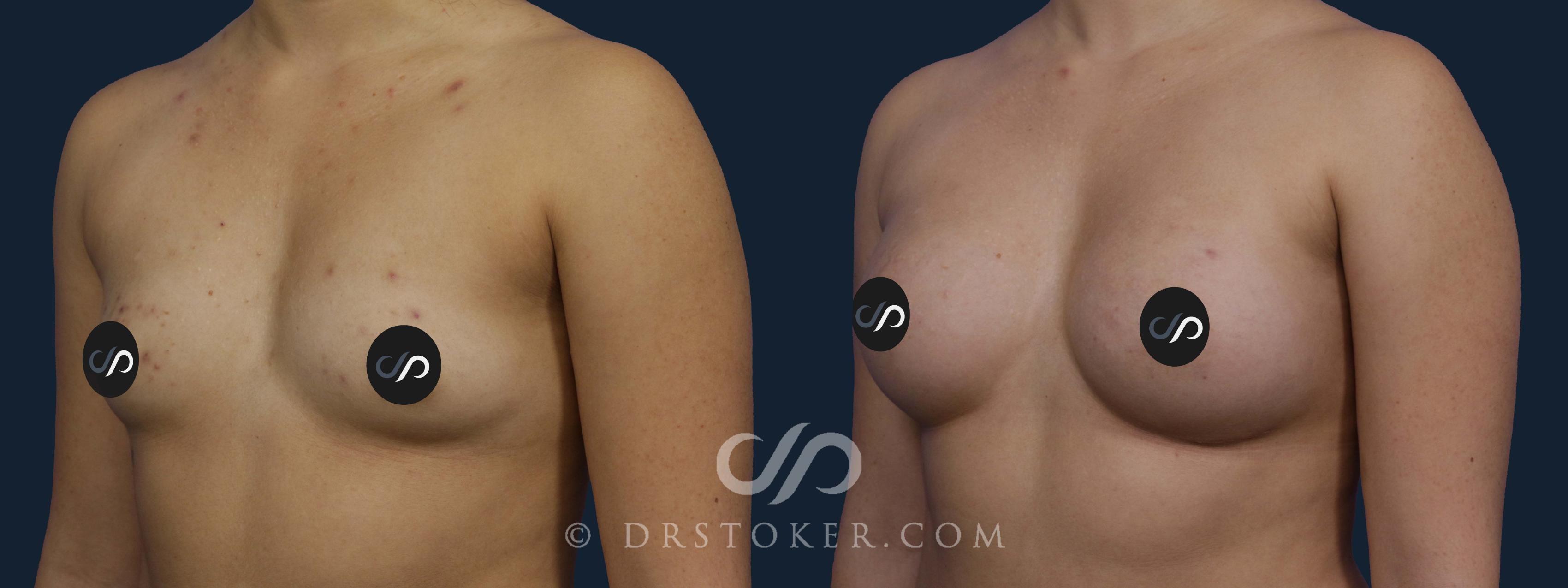 Before & After Breast Augmentation, Rapid Recovery Case 2041 Left Oblique View in Los Angeles, CA