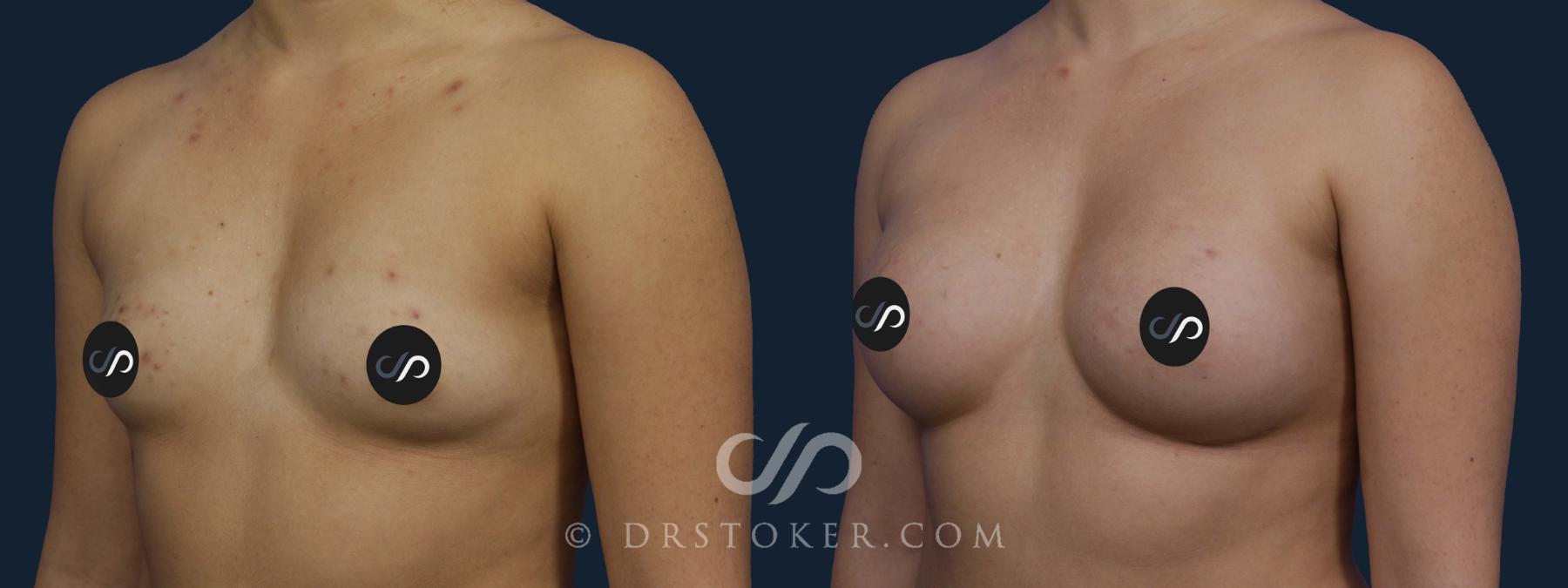 Before & After Breast Augmentation, Rapid Recovery Case 2041 Left Oblique View in Los Angeles, CA