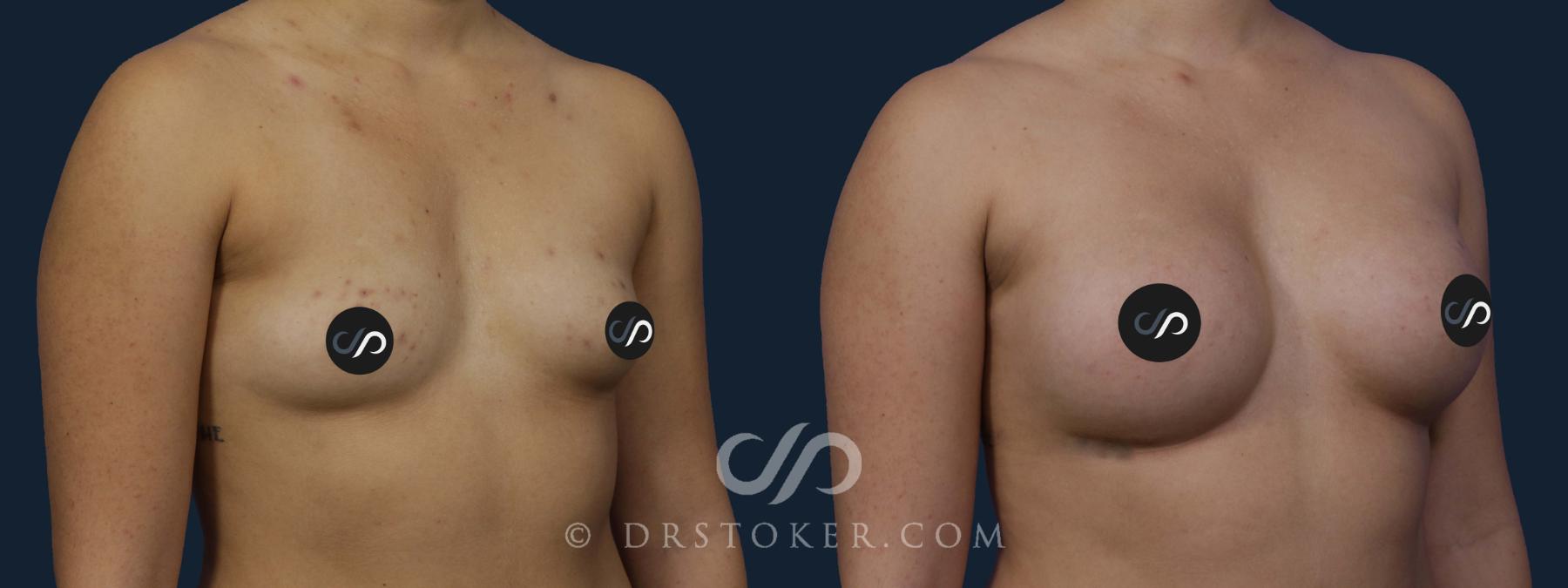 Before & After Breast Augmentation, Rapid Recovery Case 2041 Right Oblique View in Los Angeles, CA