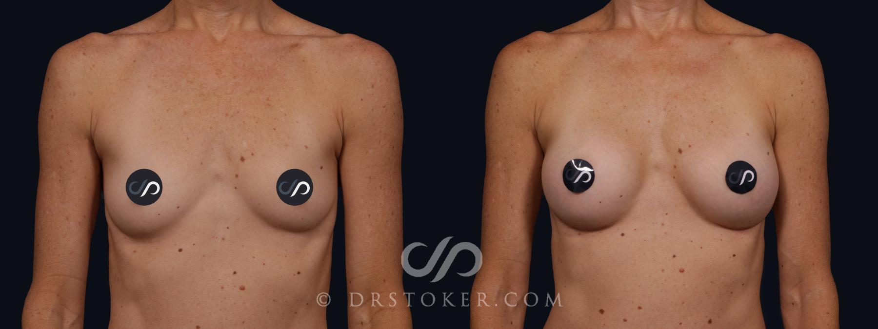 Before & After Breast Augmentation, Rapid Recovery Case 2065 Front View in Los Angeles, CA